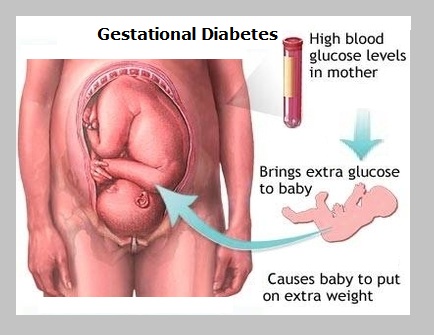 gestational diabetes