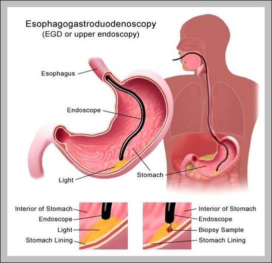 esophagus pictures