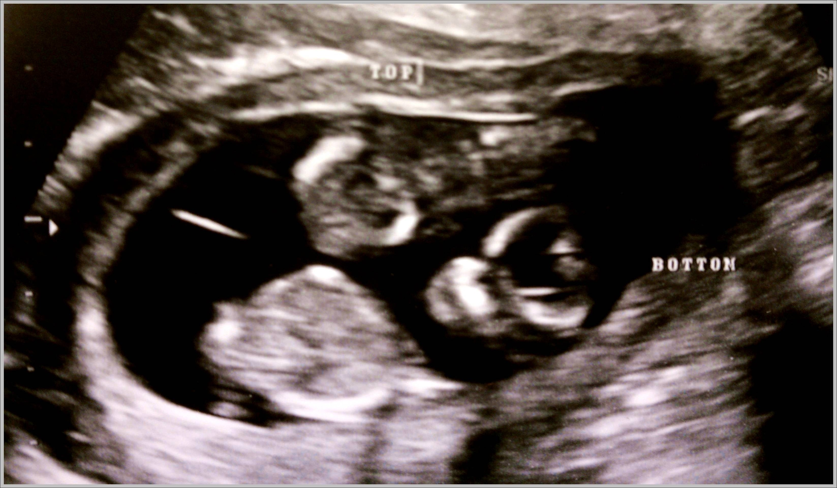 identical twin ultrasound