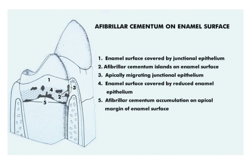 Afibrillar Cementum on Enamel Surface