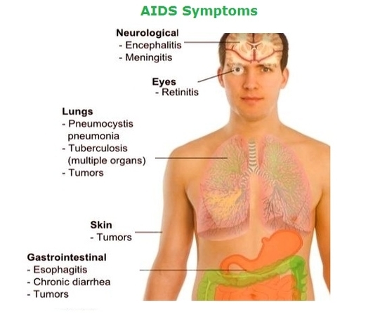 Aids Symptoms Image