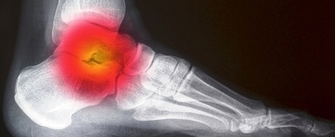 Ankle Pain Xray Image