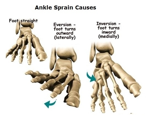 Ankle Sprain Causes Image
