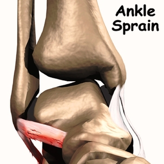 Ankle Sprain Chart Image