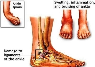 Ankle Sprains Adam Image