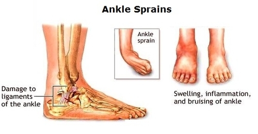 Ankle Sprains Diagram Image