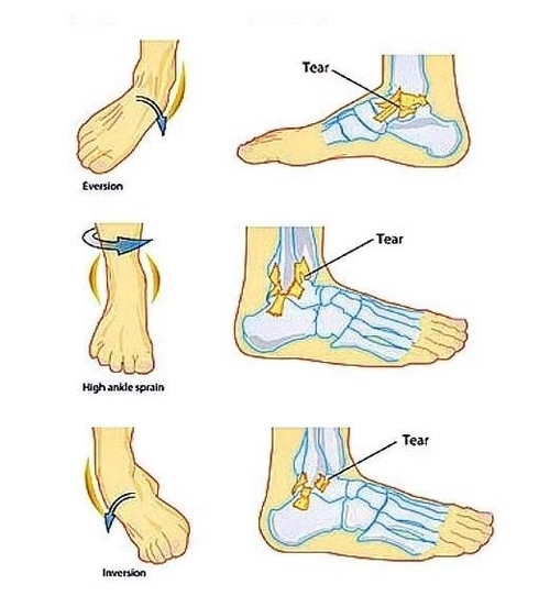 Ankle Sprains Types Image