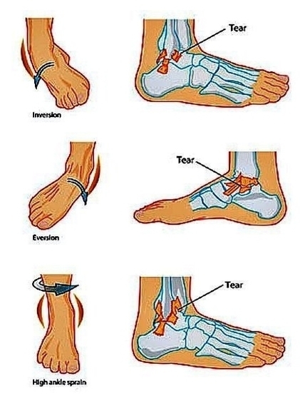 Ankle Sprains Types1 Image