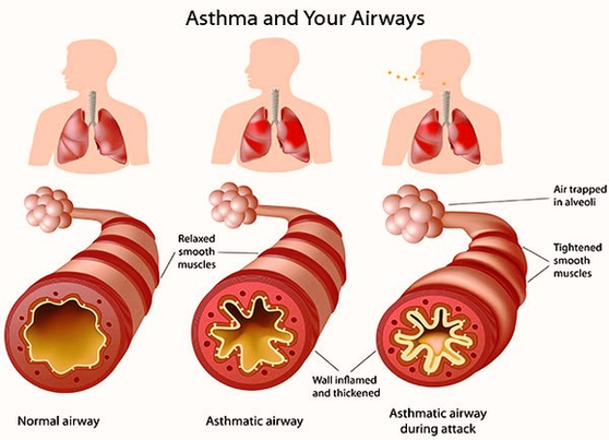 Asthma Airways Image