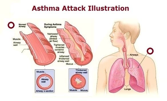 Asthma Attack Illustration Image