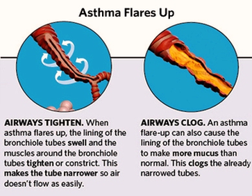 Asthma Attack Steps Image