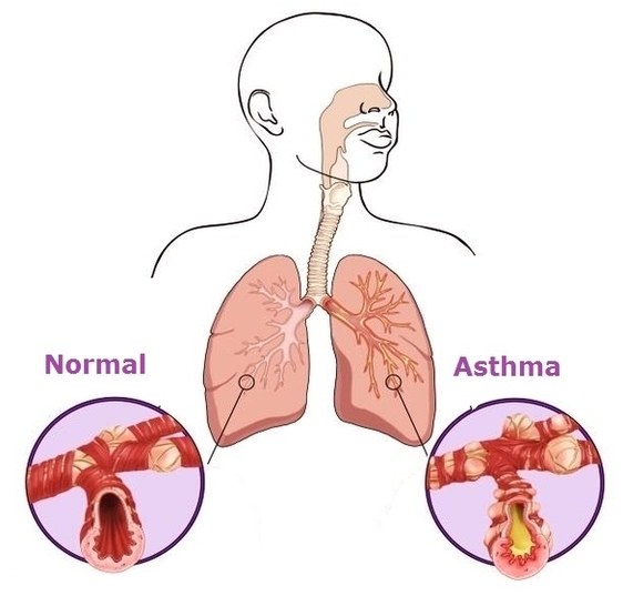 Asthma Diagram Image - Graph Diagram