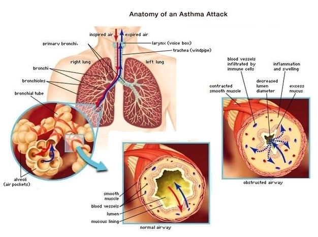Asthma Explained Image