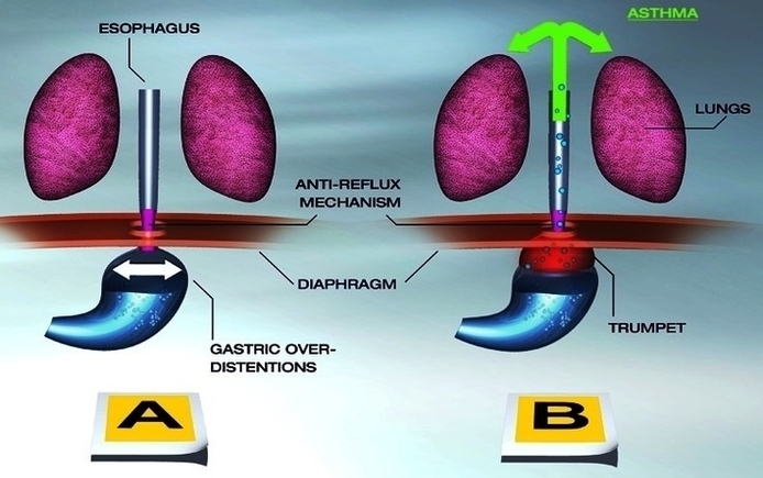 Asthma Explained1 Image