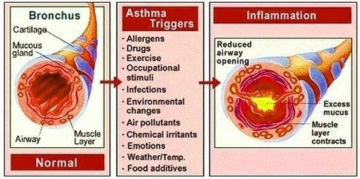 Asthma Triggers Image
