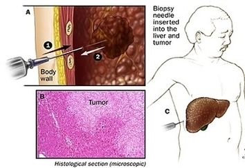 Biopsy Focal Tumor Image