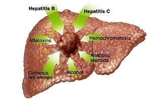 Causes Hepatocellular Carcinoma Image