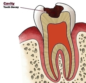 Cavity Tooth Decay Small Image