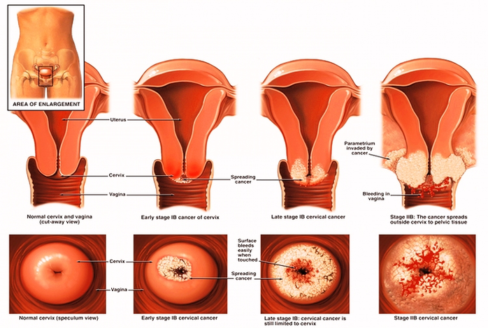 Cervical Cancer Screening Bchjzgid Image