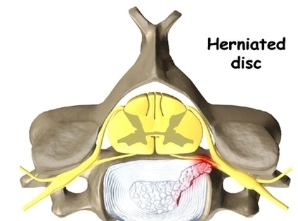 Cervical Discectomy Rationale Image
