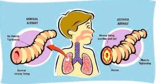 Child Asthma Image