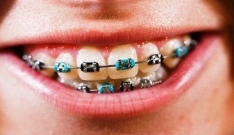 Close Up Kid With Braces Image