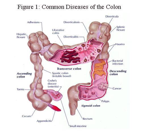 Colon Cancer Diagram Image