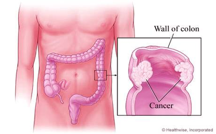 Colon Cancer Explained Image