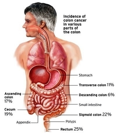 Colon Cancer Incidence Image