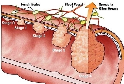 Colon Cancer Stage Image