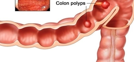 Colon Cancer Stages Early Detection Image