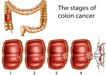 Colon Cancer Stages Image