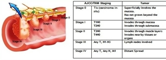 Colon Stages Detailed Image