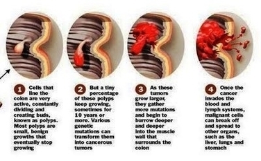 Coloncancer Process Image