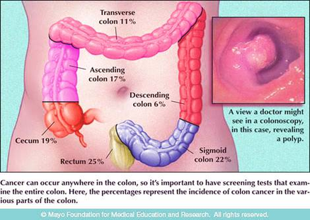 Colorectal Cancer Lg Image