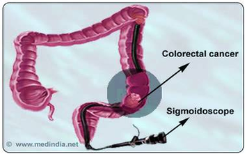 Colorectal Cancer Screening Image