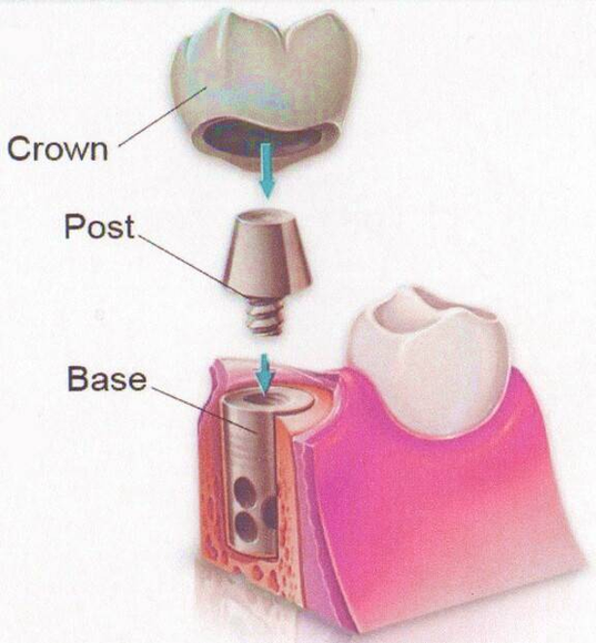 Corvallis Dental Implants Figure Image