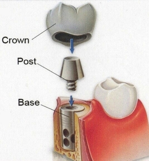 Corvallis Dental Implants Image