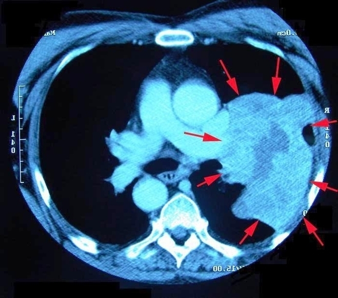 Ct Scan Lung Cancer Image