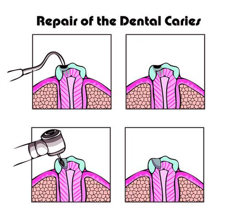 Dental Cavity Repair Photo Image