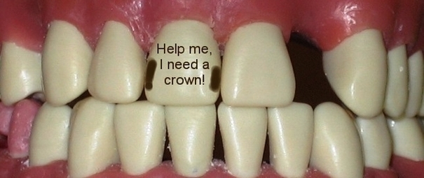 Dental Crown Tooth Before Image