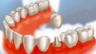 Dental Crowns Lake County Il1 Image