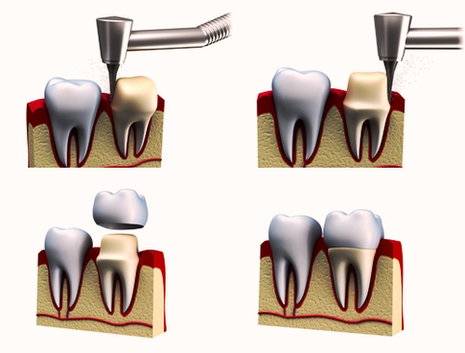 Dental Crowns Procedure Image