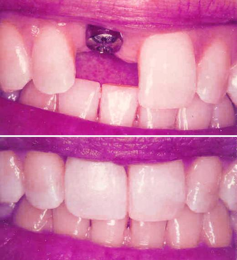 Dental Implant Before And Afters Image