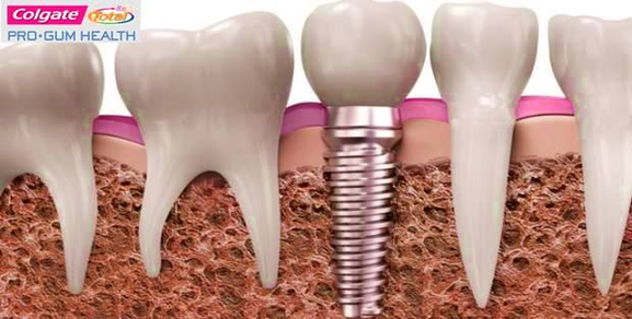 Dental Implant Colgate Diagram Image