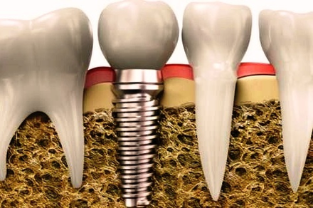 Dental Implant Colgate Image