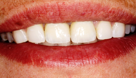 Dental Implant St After Smile Resized Image
