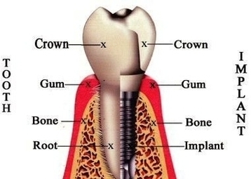Dental Implants Gilbert Az Image