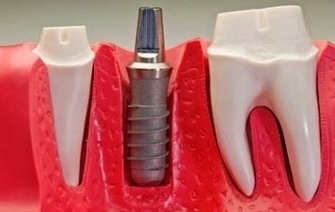 Dental Implants Mesa Image