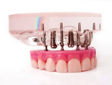 Dental Implants Success Your Shape Blogs Image